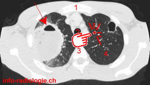 Abcès pulmonaire.  Image 0