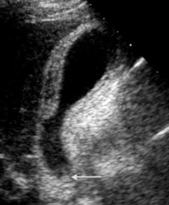 aspect ultrasonographique d'une cholécystite aiguë - coupe  longitudinale