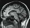 resonance magnetique du cerveau