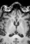 Lobe frontal, IRM, coupe sagittale, Pondération T1. Niveau 1. Image 2. 