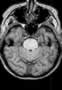 gyrus-temporo-occipital-lateral-2_fs