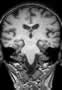 gyrus-temporo-occipital-lateral-3_fs
