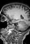gyrus-temporo-occipital-medial-1_fs