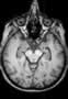 gyrus-temporo-occipital-medial-2_fs