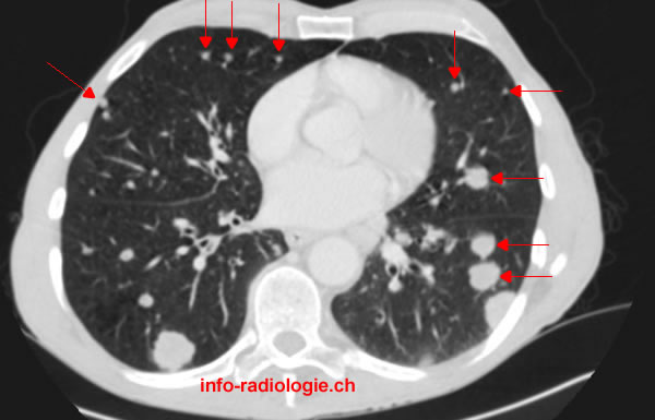 cancer de poumon pdf