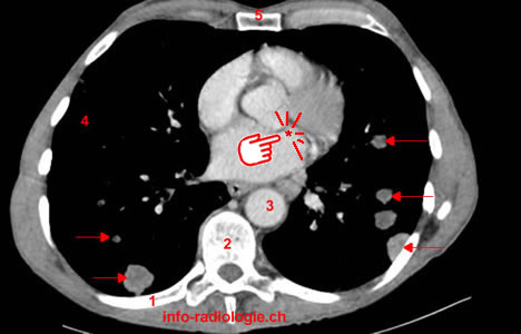 Métastases pulmonaires. Image 0