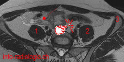 Appendicite aigü: aspect en IRM. Image 1