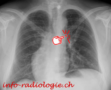 Radiographie de face du thorax: dextrocardie