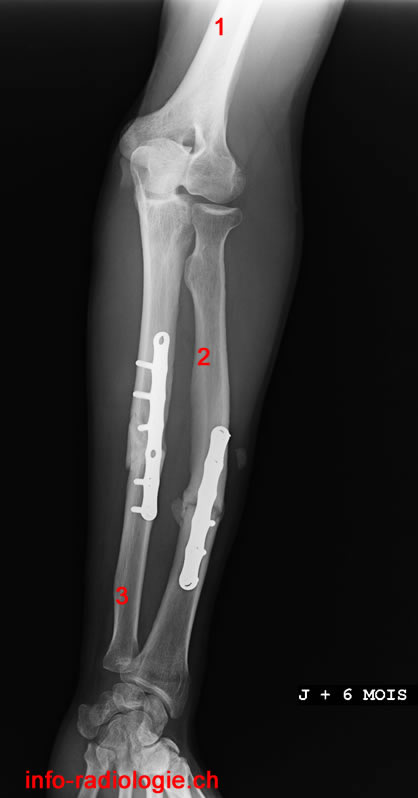 Os De L Avant Bras En 4 Lettres Fracture des deux os de l'avant-bras (adulte)