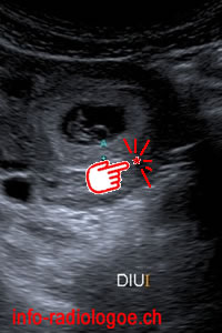 DIU avec grossesse intrautérine. Image 0.