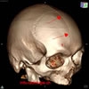 Fracture du crâne et hématome sous-dural bilatéral chronique. Image 2.