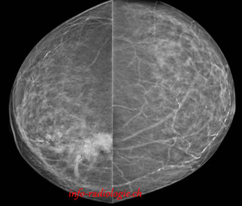 Tumeur du sein droit visible au scanner, Image 1.
