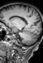 Sillon pariéto-occipital, IRM, coupe sagittale, Pondération T1. Image 4.
