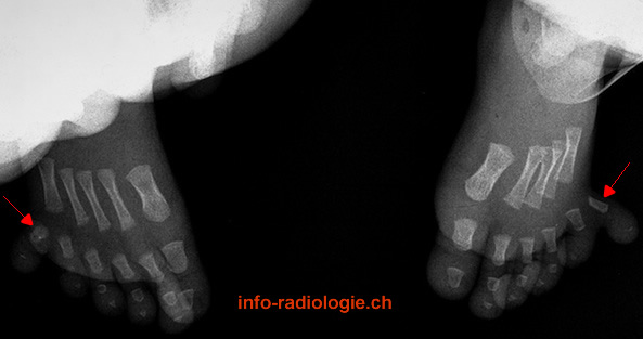 Polydactylie post-axiale (pied). Image 1