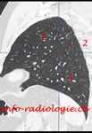 poumon-sagittal-3-tmb