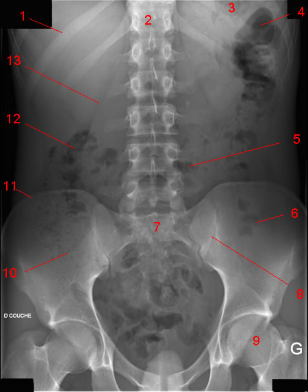 Radiographie de l'abdomen sans préparation