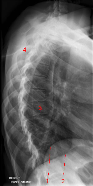 Transverse Process Fracture - Fracture Treatment