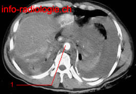 Rupture aorte thoracique. image 1