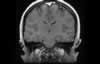 Sinus veineux du cerveau: coupe coronale IRM du cerveau après gadolinium. Image 1