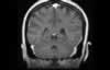 Sinus veineux du cerveau: coupe coronale IRM du cerveau après gadolinium. Image 4