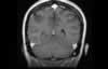 Sinus veineux du cerveau: coupe coronale IRM du cerveau après gadolinium. Image 5