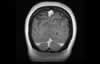 Sinus veineux du cerveau: coupe coronale IRM du cerveau après gadolinium. Image 9