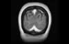 Sinus veineux du cerveau: coupe coronale IRM du cerveau après gadolinium. IMage 10