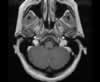 Sinus veineux du cerveau: coupes axiales (IRM du cerveau avec gadolinium). Image 2