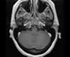 Sinus veineux du cerveau: coupes axiales (IRM du cerveau avec gadolinium). Image 3