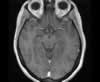 Sinus veineux du cerveau: coupes axiales (IRM du cerveau avec gadolinium). Image 7