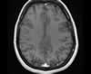 Sinus veineux du cerveau: coupes axiales (IRM du cerveau avec gadolinium). Image 13