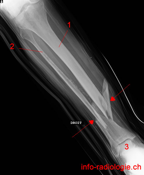 Fracture spiroïde, comminutive, du tibia distal associée à une fracture de la fibula distal. Image 1.