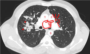 Tuberculose pulmonaire. Image 0
