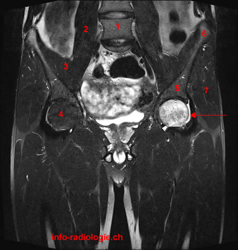 Algodystrophie de la hanche. Image 1