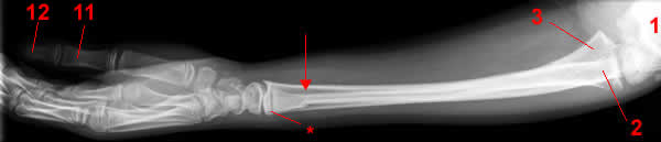 radiographie de l'avant-bras, profil