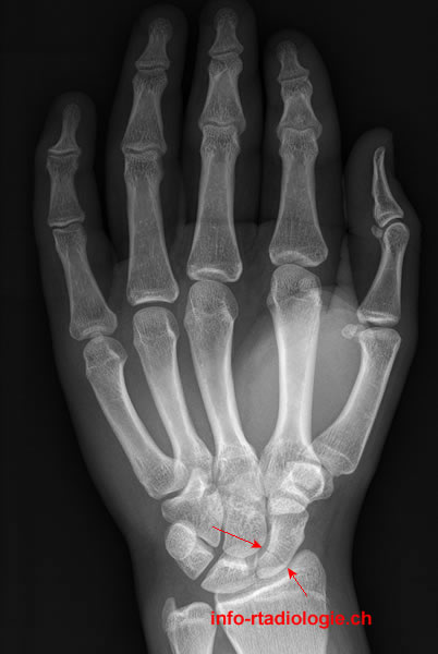 Radiographie de la main / poignet (face)