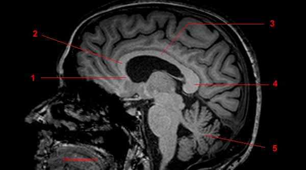 Corps calleux; corpus callosum