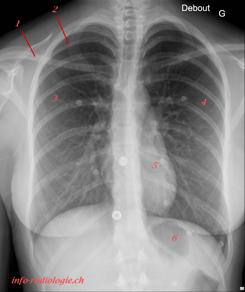 Radiographie du thorax (face)
