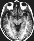 IRM cerveau: coupe axiale
