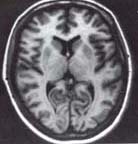 IRM cérébral