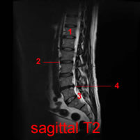 sagittal_t2_6_fs