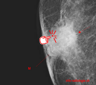 Cancer du sein chez l'homme. Image 0.