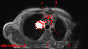 Tumeur pulmonaire.  Image 0