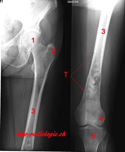 Ostéosarcome. Image 1