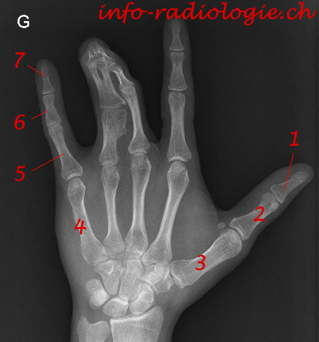 syndactylie-1