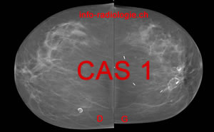 Cytosteatonecrose. Image 1