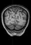 Sillon pariéto-occipital, IRM, coupe coronale, Pondération T1. Image 3. 
