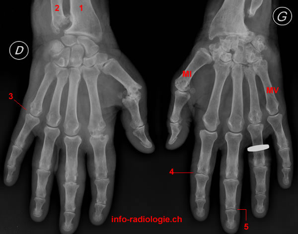Polyarthrite rhumatoïde. Image 1