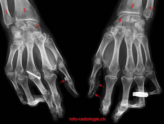 Sclérodermie (atteinte des mains). Image 1