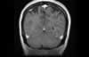 Sinus veineux du cerveau: coupe coronale IRM du cerveau après gadolinium. Image 6